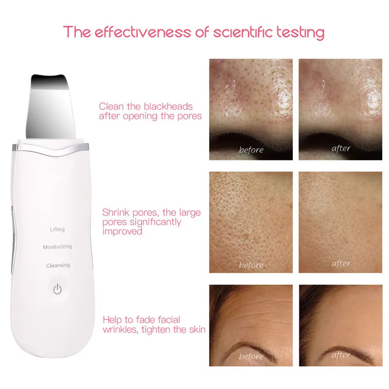 Ultrasonic Skin Spatula Deep Pore Cleaner and Blackhead Remover for Face Daily Skincare - 8