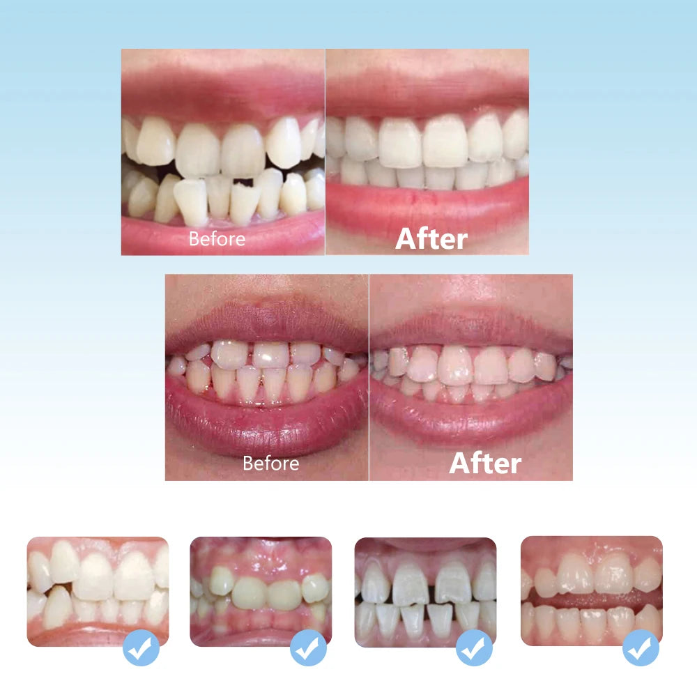 Dental Orthodontic Braces Set Silicone Teeth Alignment Trainer for Kids during Day and Night - 7