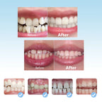 Dental Orthodontic Braces Set Silicone Teeth Alignment Trainer for Kids during Day and Night