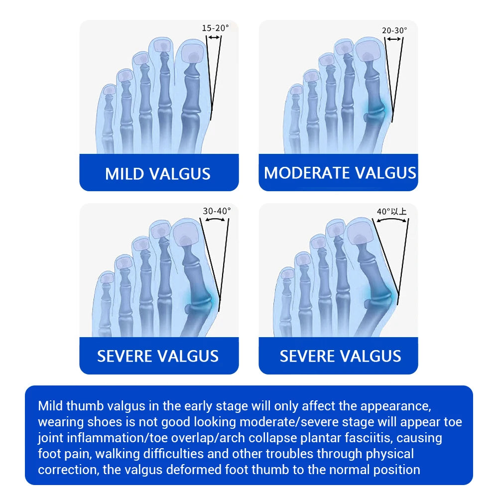 Big Toe Valgus Corrector Adjustable Bunion Splint for Painless Foot Relief at Home - 5