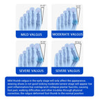 Big Toe Valgus Corrector Adjustable Bunion Splint for Painless Foot Relief at Home