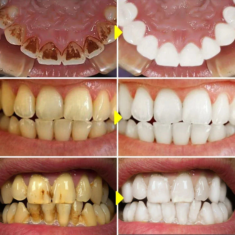 Probiotic Toothpaste Stain Removal and Teeth Whitening for Adults at Home