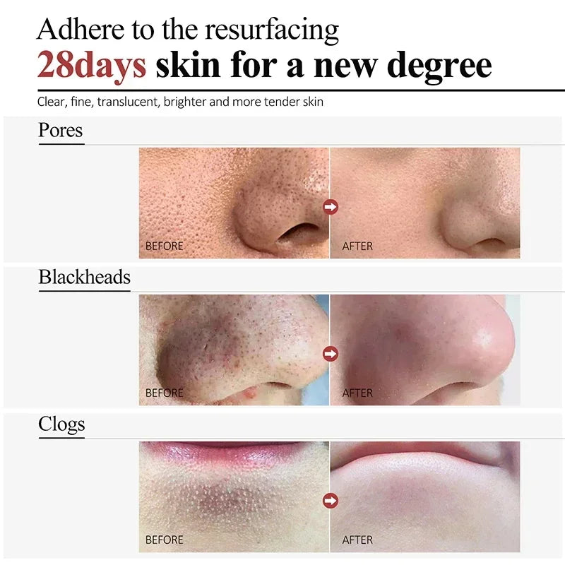 Salicylic Acid Pore Shrinking Cream Skin Repair Acne Treatment for Face and Smooth Texture