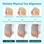 Big Toe Valgus Corrector Adjustable Bunion Splint for Painless Foot Relief at Home