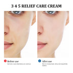 345 Relief Care Cream Moisturizing Acne Treatment for Blemish Prone Skin