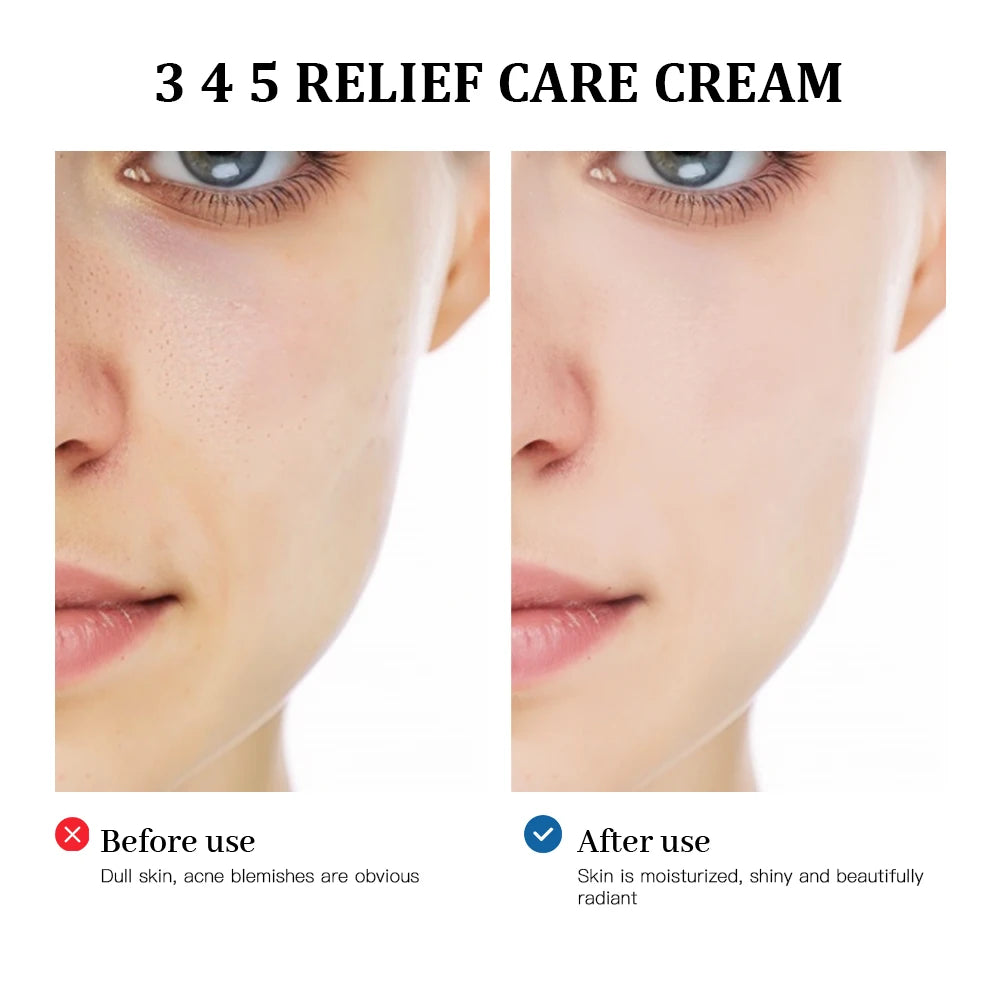 345 Relief Care Cream Moisturizing Acne Treatment for Blemish Prone Skin