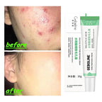 Salicylic Acid Pore Shrinking Cream Skin Repair Acne Treatment for Face and Smooth Texture