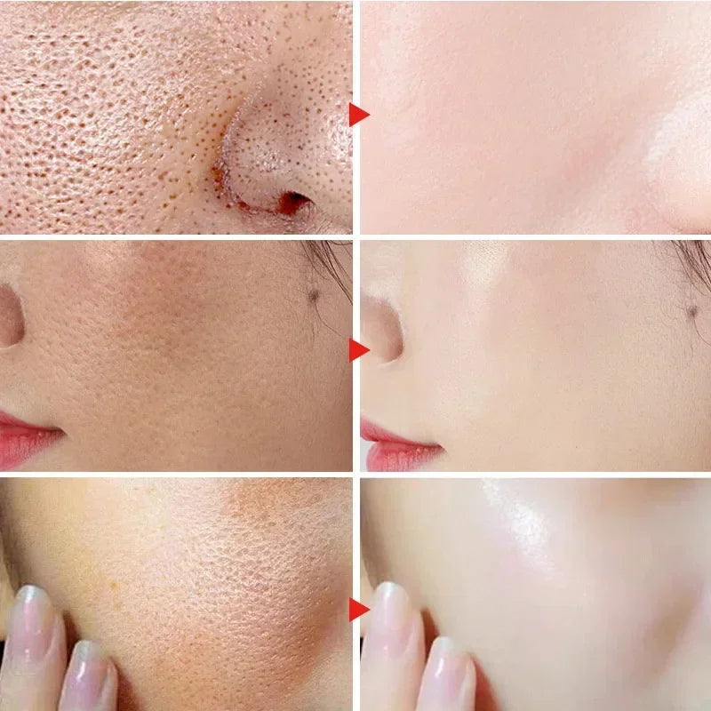 Salicylic Acid Pore Shrinking Cream Skin Repair Acne Treatment for Face and Smooth Texture