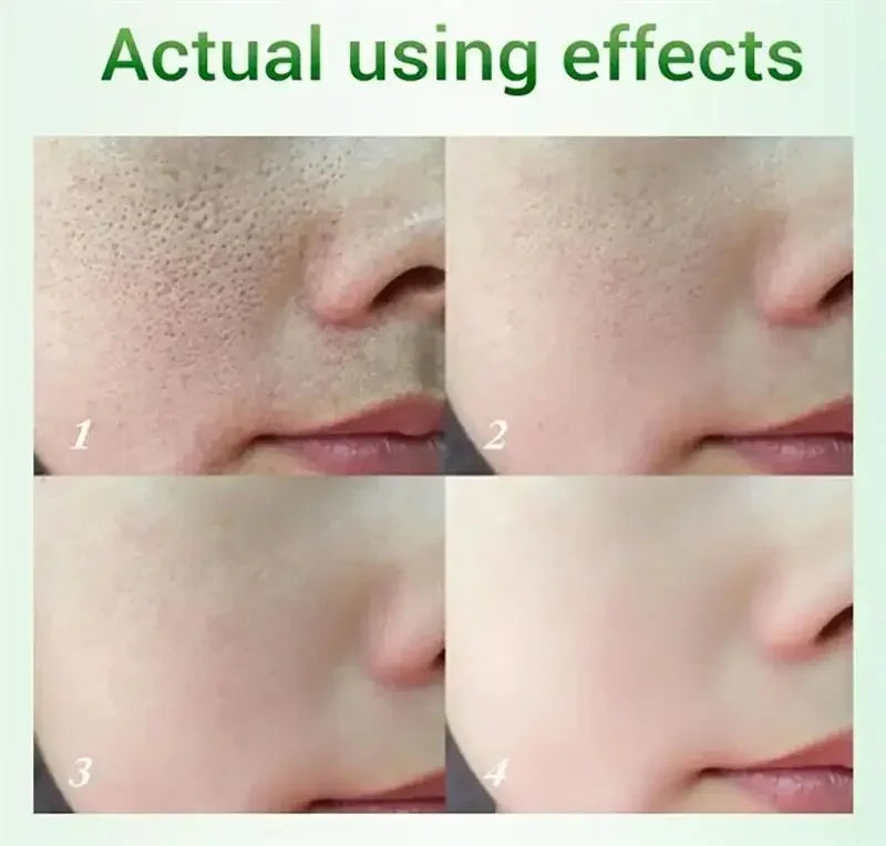 Salicylic Acid Pore Shrinking Cream Skin Repair Acne Treatment for Face and Smooth Texture