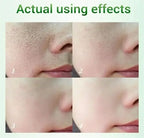 Salicylic Acid Pore Shrinking Cream Skin Repair Acne Treatment for Face and Smooth Texture