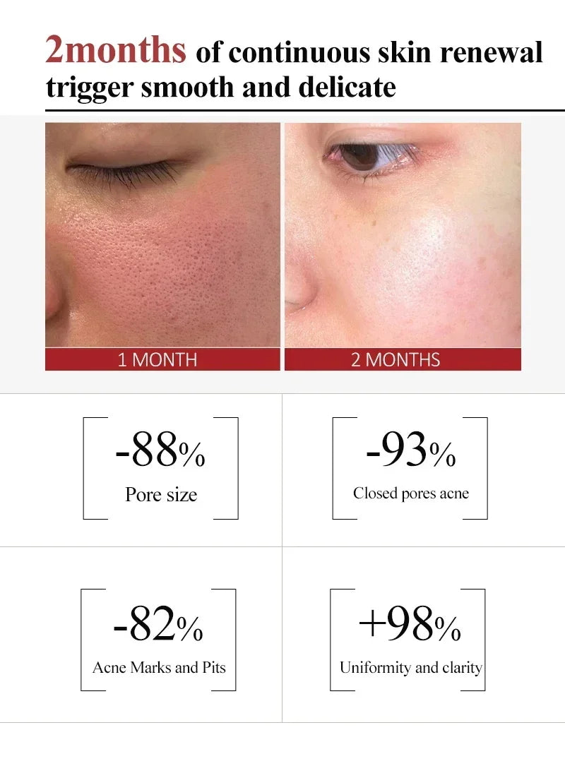 Salicylic Acid Pore Shrinking Cream Skin Repair Acne Treatment for Face and Smooth Texture - 14