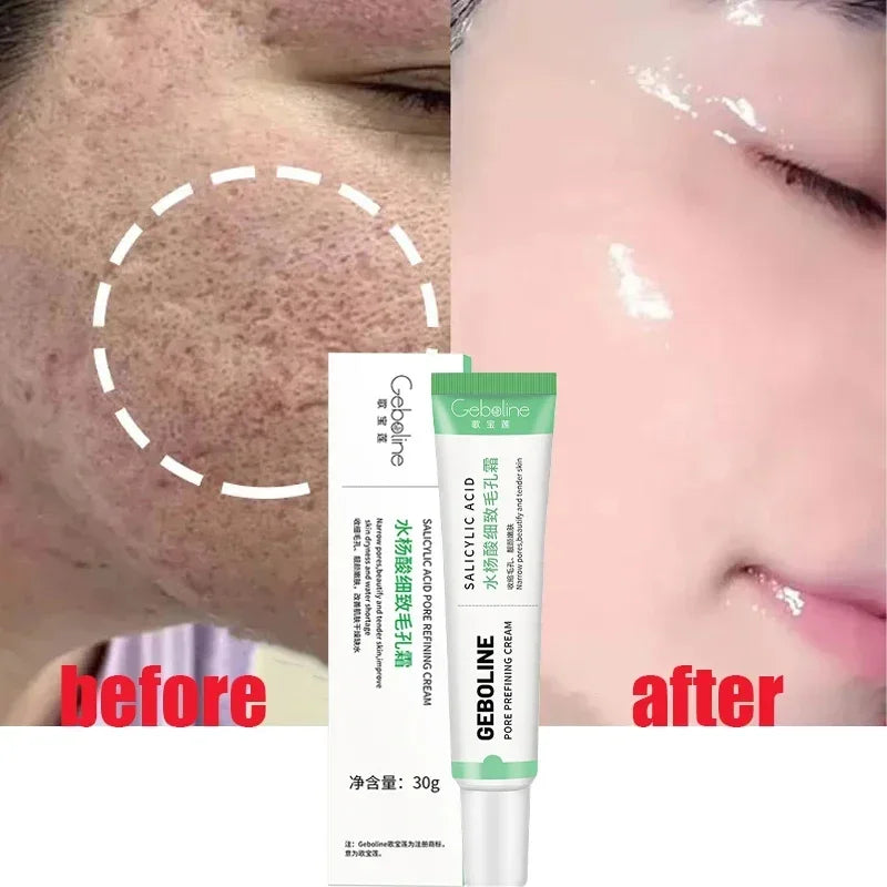 Salicylic Acid Pore Shrinking Cream Skin Repair Acne Treatment for Face and Smooth Texture - 1