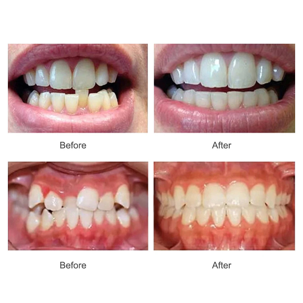 Dental Braces Teeth Trainer Alignment Mouthpiece for Adults Daily Corrective Use - 6